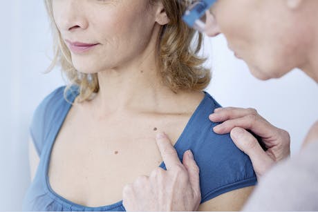 Doctor examining a female patient as part of skin cancer prevention